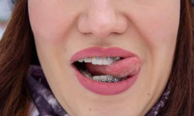 narrow palate