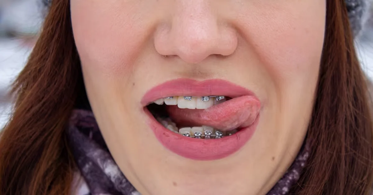 narrow palate